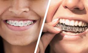 Invisible Braces: How Invisalign Enhances Oral Health Beyond Aesthetics