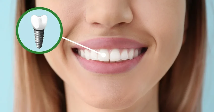 How Dental Implants Influence Your Digestive Health and Nutritional Wellbeing